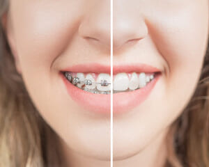鈴鹿市の歯医者「大木歯科医院」の歯科ブログ-ワイヤー矯正とマウスピース矯正の違いについてのイメージ