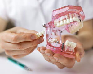 鈴鹿市の歯医者「大木歯科医院」の歯科ブログ-インプラントと入れ歯の違いと選び方のイメージ