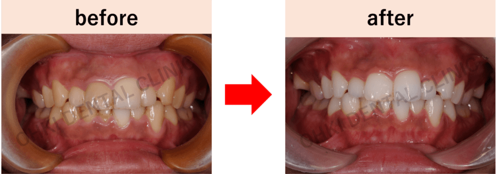 ホワイトニングbefore after